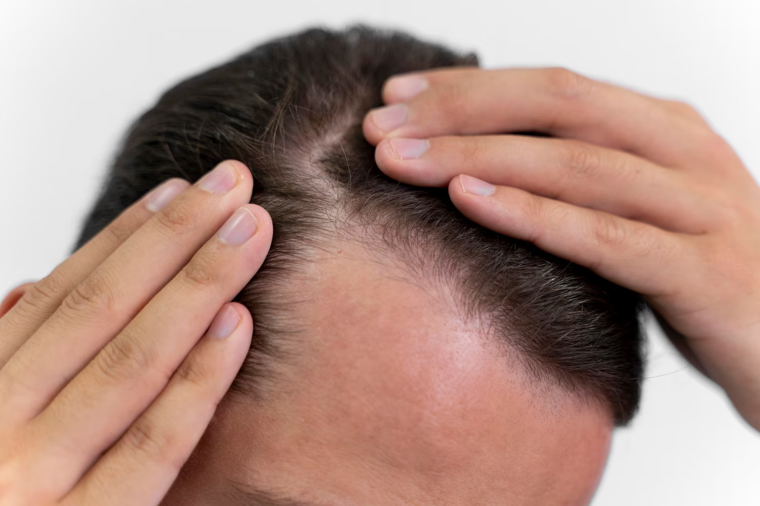 The Science Behind Hair Loss and Effective Treatments by Mrhims
